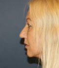 Feel Beautiful - Rhinoplasty SD 227 - Before Photo